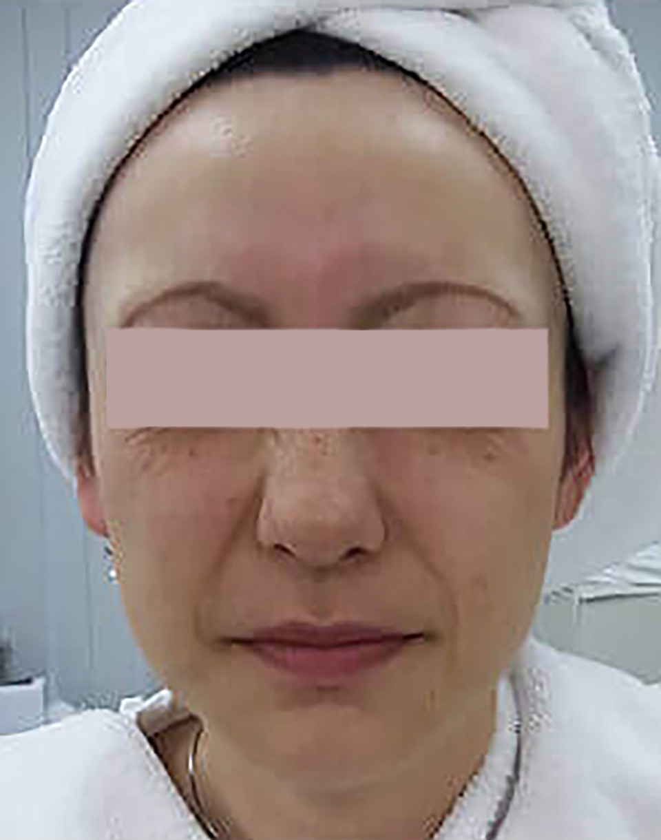 After：2週間後