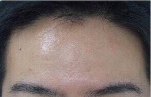 After：2週間後