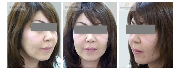 ウルセラで効果が高い症例写真 アフター