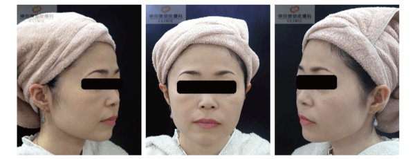 ウルセラで効果が高い症例写真 アフター