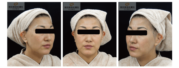 ウルセラで効果が高い症例写真 アフター