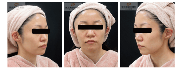 ウルセラで効果が高い症例写真 アフター