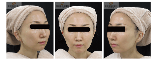 ウルセラで効果が高い症例写真 アフター