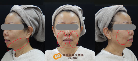 ウルセラで効果が高い症例写真 アフター