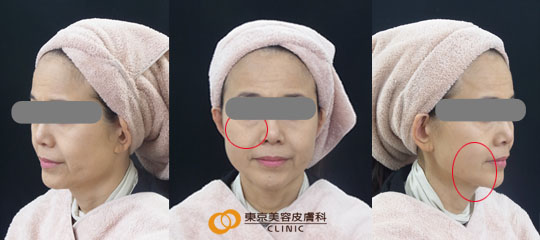 ウルセラで効果が高い症例写真 アフター