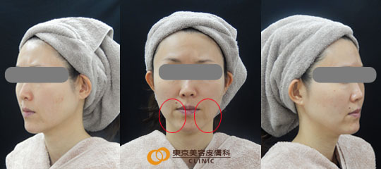 ウルセラで効果が高い症例写真 アフター