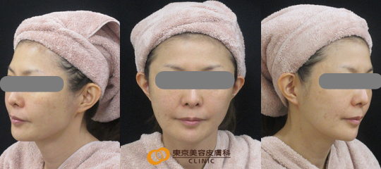 ウルセラで効果が高い症例写真 ビフォー