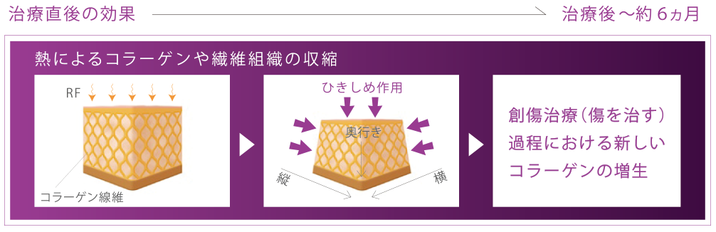 熱によるコラーゲンや繊維組織の収縮