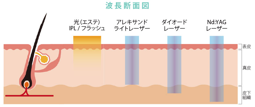 ハイフシャワーのアプローチ