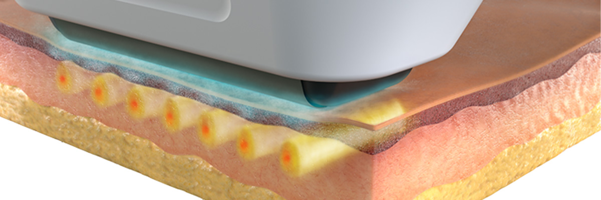 ソフウェーブはなぜ人気なの?その理由とは