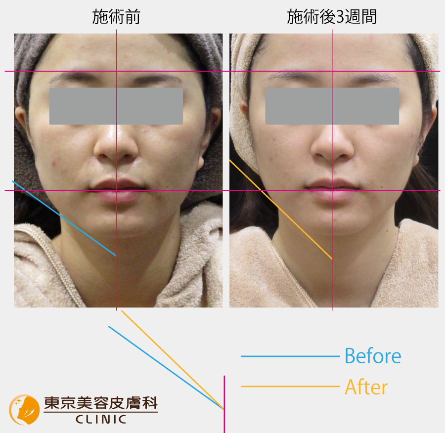 ほうれい線と輪郭への効果：施術後3週間