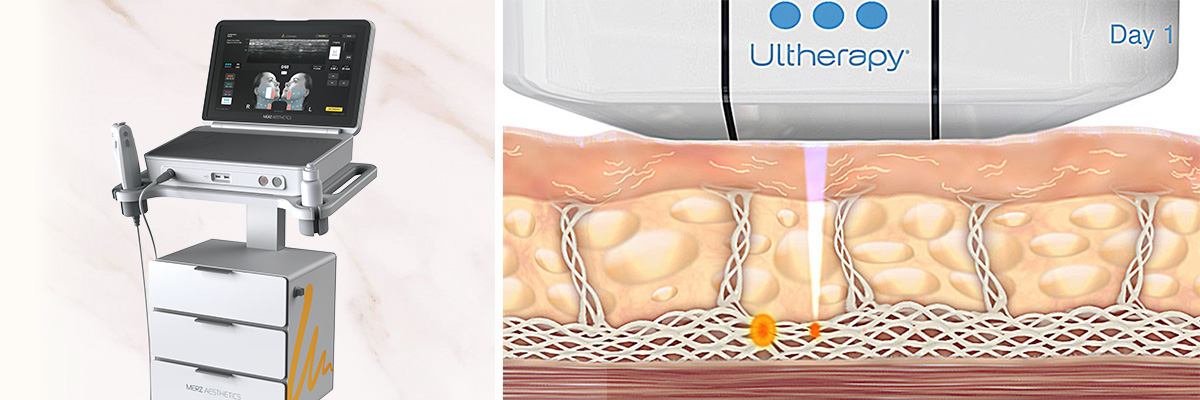 【リフトアップの王者】ウルセラプライム（医療ハイフ）