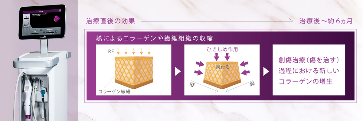 【小顔タイトニング】サーマクールFLX（高周波RF）
