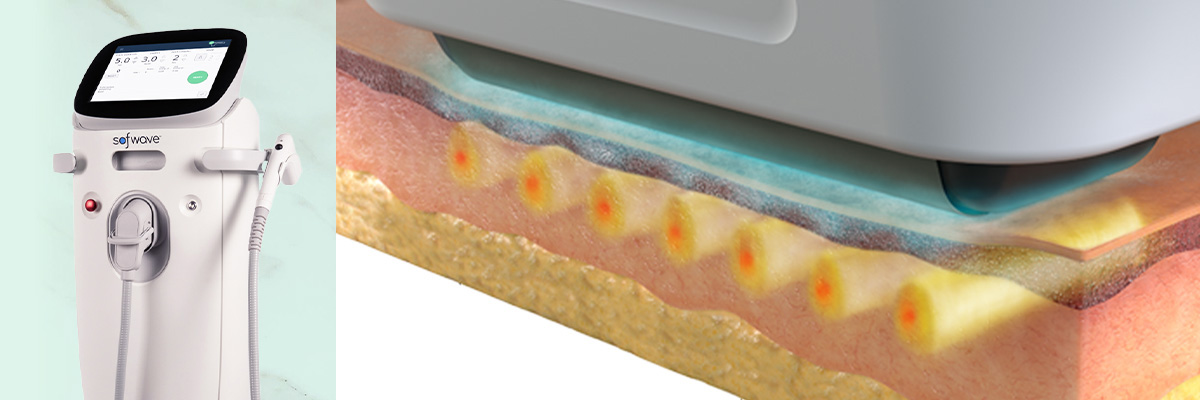 【皮膚のアイロン】ソフウェーブ（SUPERB）