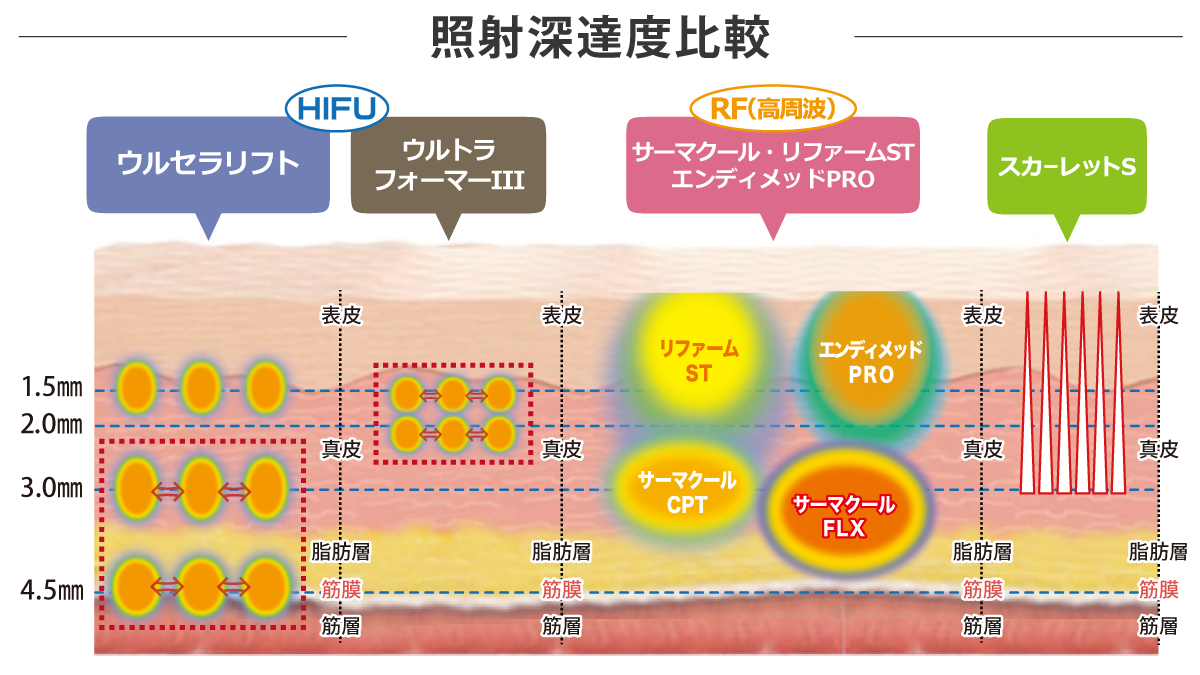 加齢と共にできてしまうたるみにはウルセラでの治療が効果的です。