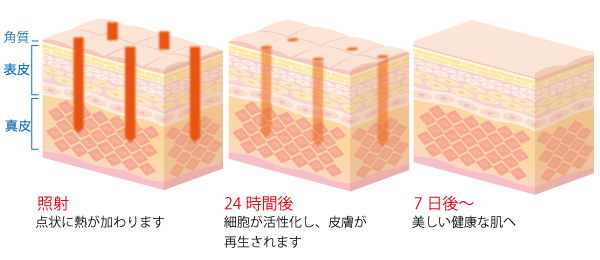 フラクショナルCO2レーザーは肌のターンオーバーに合わせて治療することが有効的です。