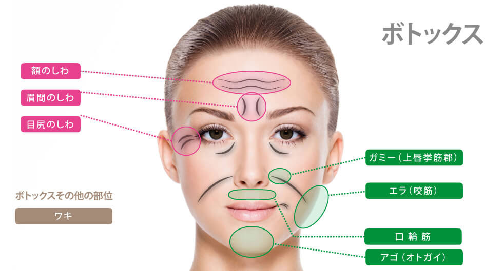 ボトックスが可能な施術部位