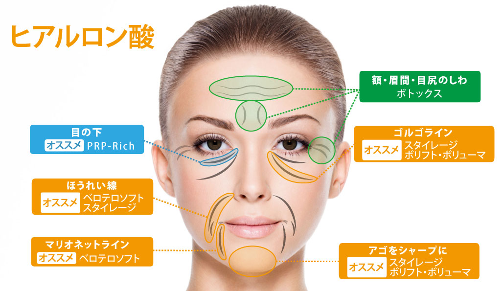 ヒアルロン酸注入の施術部位