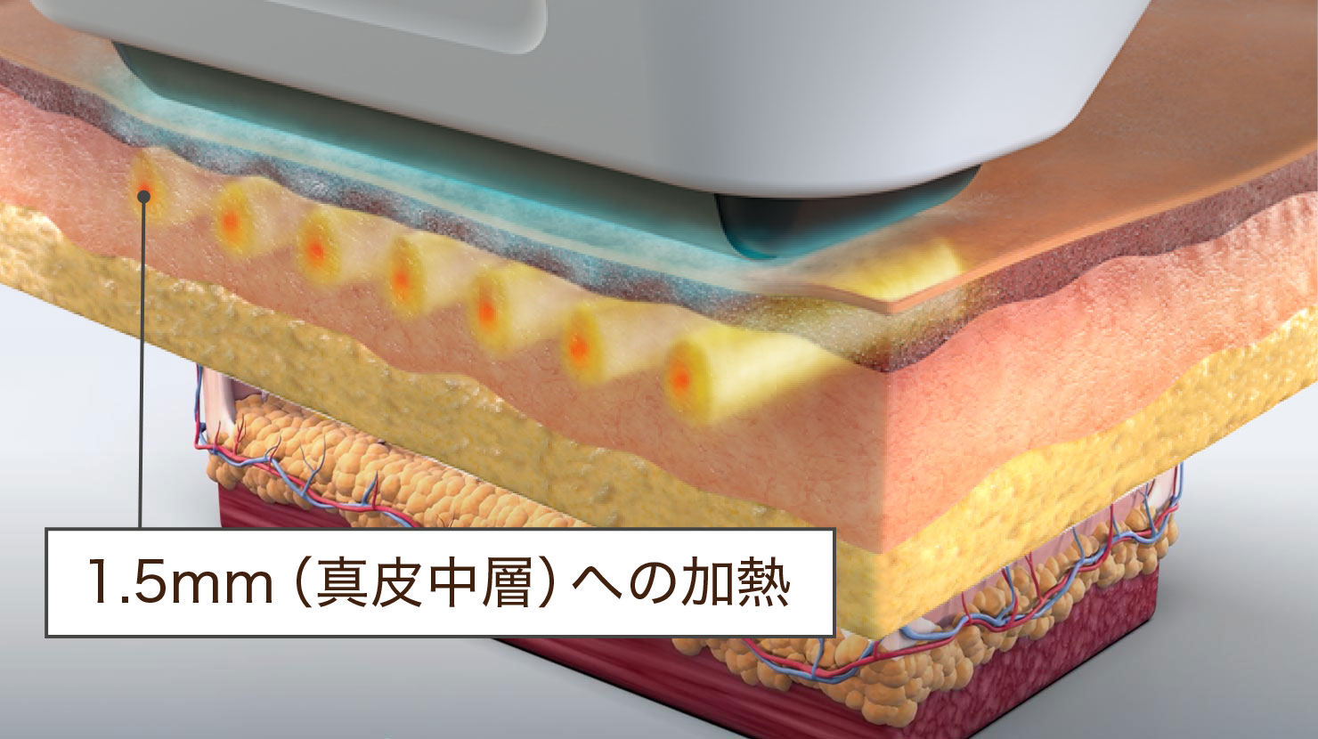 1.5mm（真皮中層）への加熱