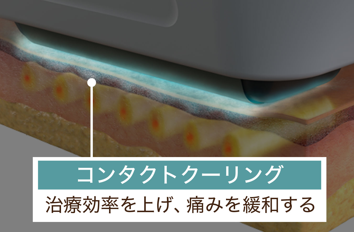 コンタクトクーリング