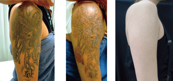 タトゥー・刺青除去の症例その1