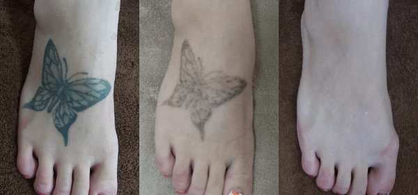タトゥー・刺青除去の症例その5
