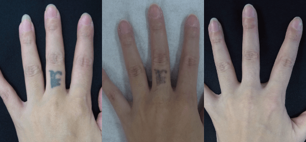 タトゥー・刺青除去の症例その6