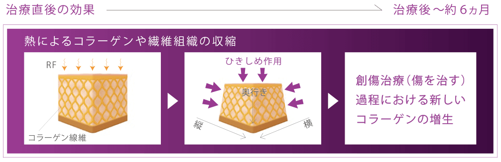 サーマクールFLXの仕組み