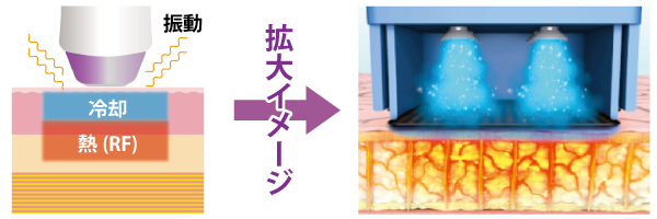 サーマクールFLXでは冷却ガスで熱感を緩和