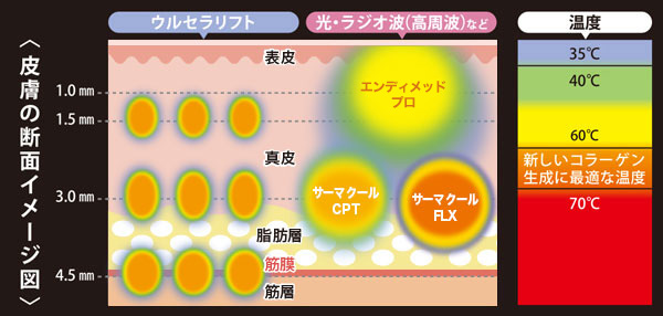 ウルセラの仕組み肌断面図の超音波の入る位置