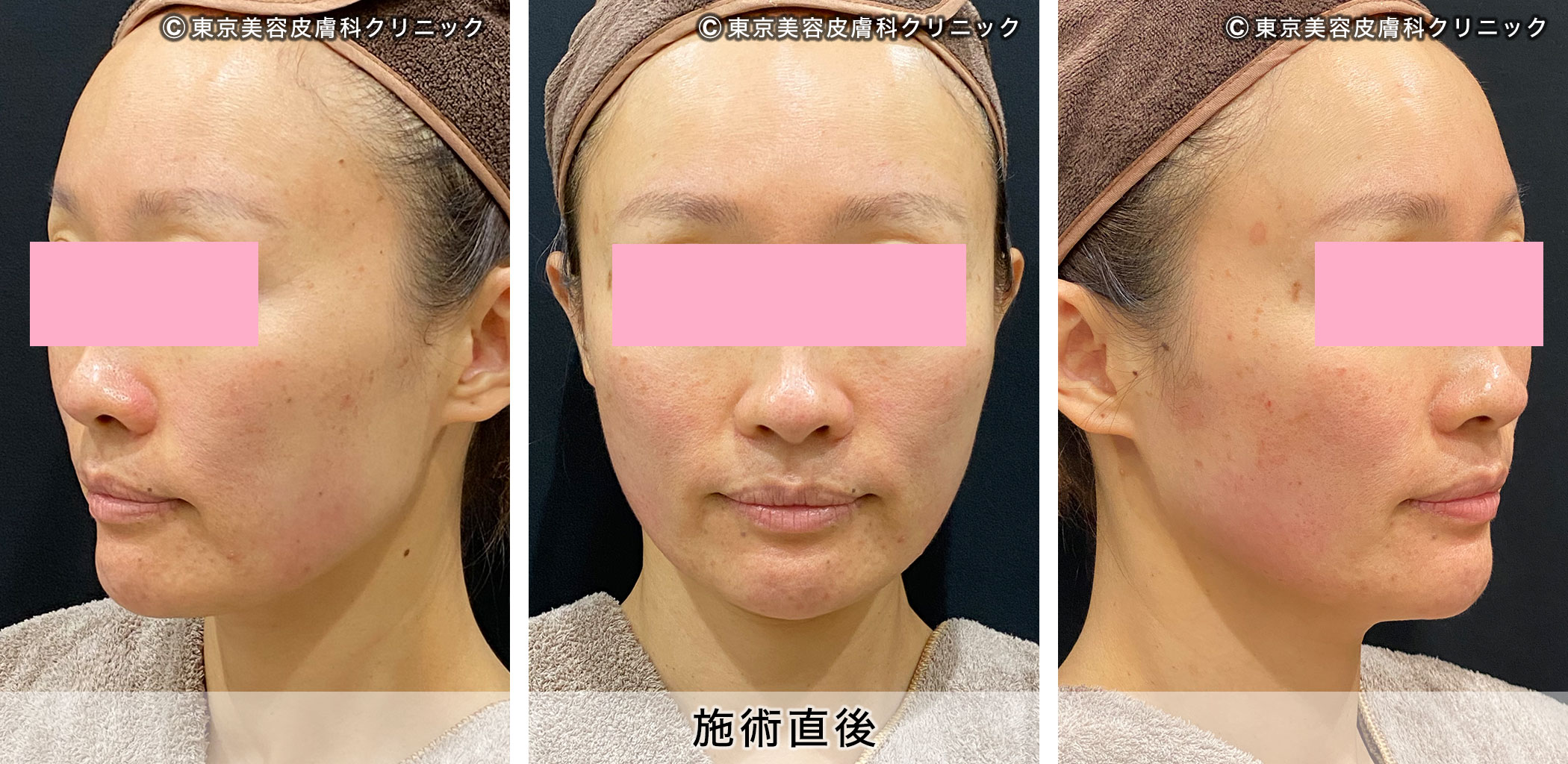 ウルセラで効果が高い症例写真 アフター