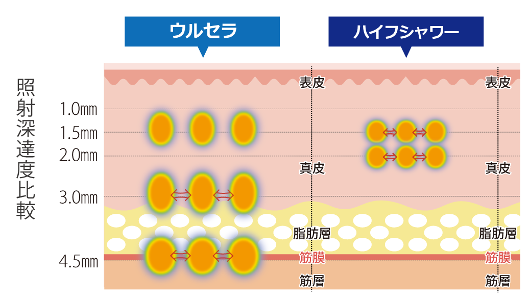 高周波（RF）バイポーラ方式のイメージ図