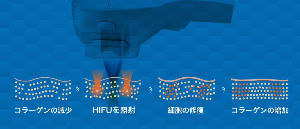 ハイフシャワーの原理・仕組み