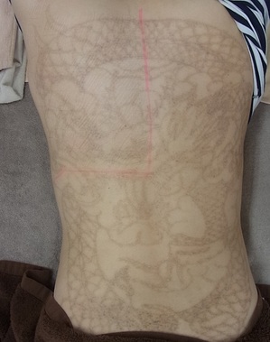 刺青レーザー除去 背中1面 の治療中の色素沈着 ウルセラ ドクターブログ 東京美容皮膚科クリニック