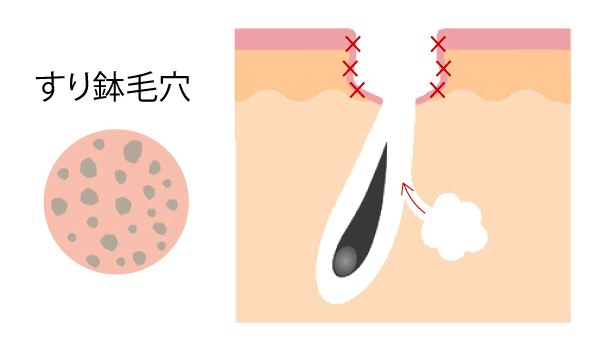 すり鉢毛穴