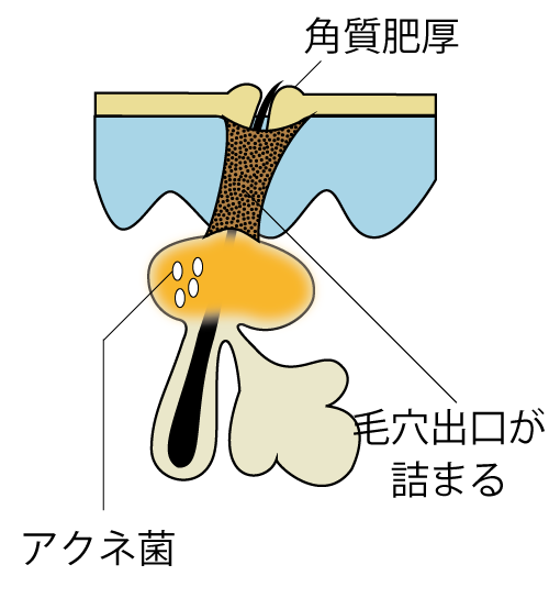 老人性色素斑のイラスト