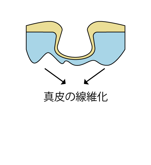 炎症後色素沈着のイラスト