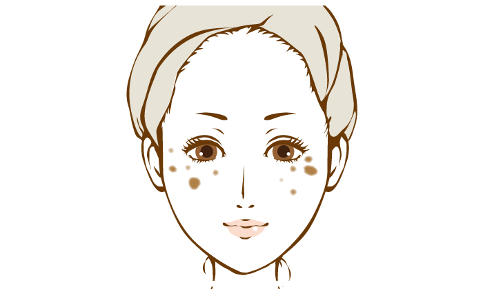 お悩み別 しみ治療 東京美容皮膚科クリニック ウルセラ サーマクールflxのたるみ治療専門 お悩み別 しみ治療 東京美容皮膚科クリニック ウルセラ サーマクールflxのたるみ治療専門