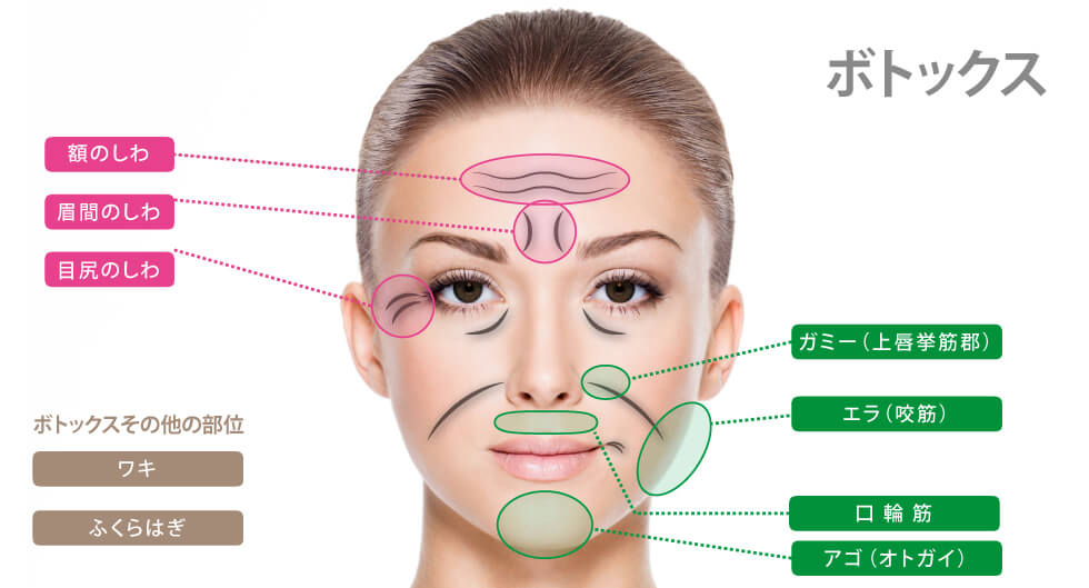 ボトックスが可能な施術部位