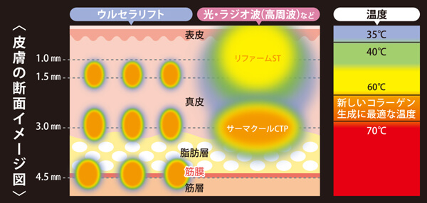 ウルセラの仕組み肌断面図の超音波の入る位置